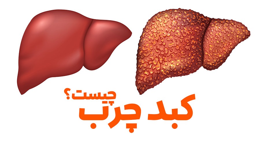 ماهیت کبد چرب